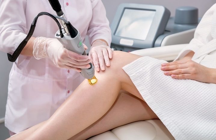 What is Laser Hair Removal?